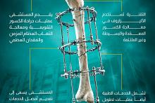 مستشفى الكفيل التخصصي يعتمد تقنية حديثة في علاج الكسور 