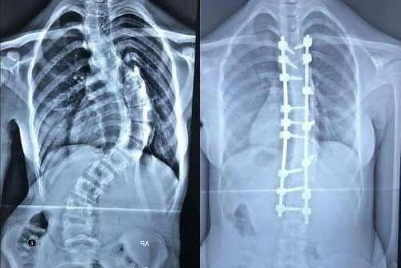 بعمليّةٍ نوعيّة: أطبّاء مستشفى الكفيل التخصّصي ينجحون في إعادة الاستقامة لظهر فتاةٍ عمرها (16) عاماً